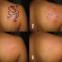 Tattonox Penghilan Tatto Efective Bersih Hilang